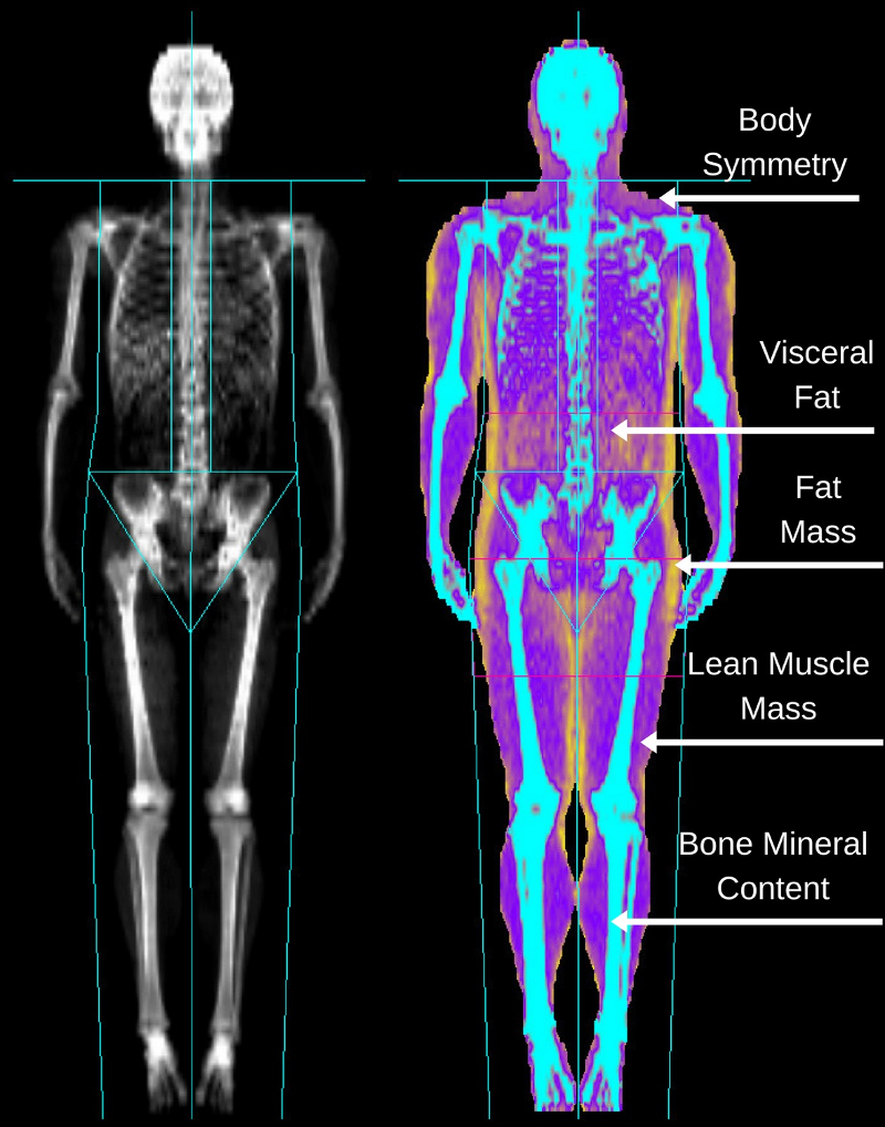 DEXA scan for assessing bone health in individuals with eating disorders